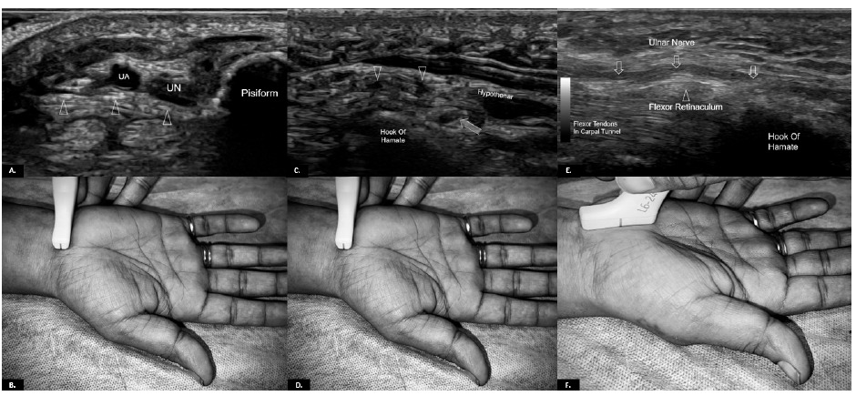 Seis paneles con ecografías y colocación del transductor para explorar el canal de Guyon proximal, distal y longitudinal
