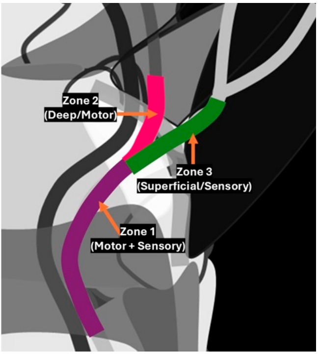Ilustración del canal de Guyon dividida en zona 1 mixta, zona 2 motora profunda y zona 3 sensitiva superficial