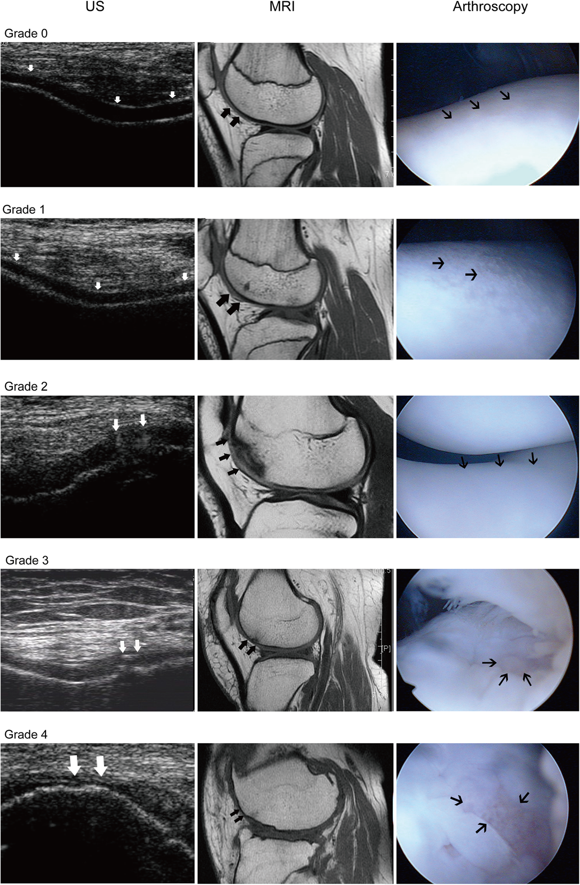 Ejemplos de grados de defecto del cartílago femoral comparados mediante ecografía, resonancia magnética y artroscopia
