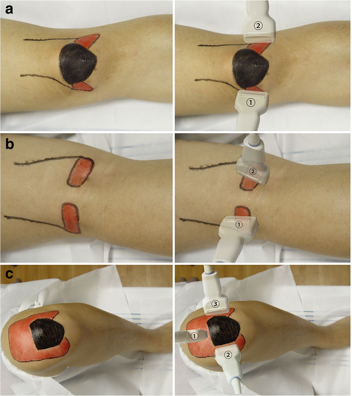 Tres posiciones de rodilla y colocaciones del transductor para explorar cartílago femoral anterior, posterior y troclear