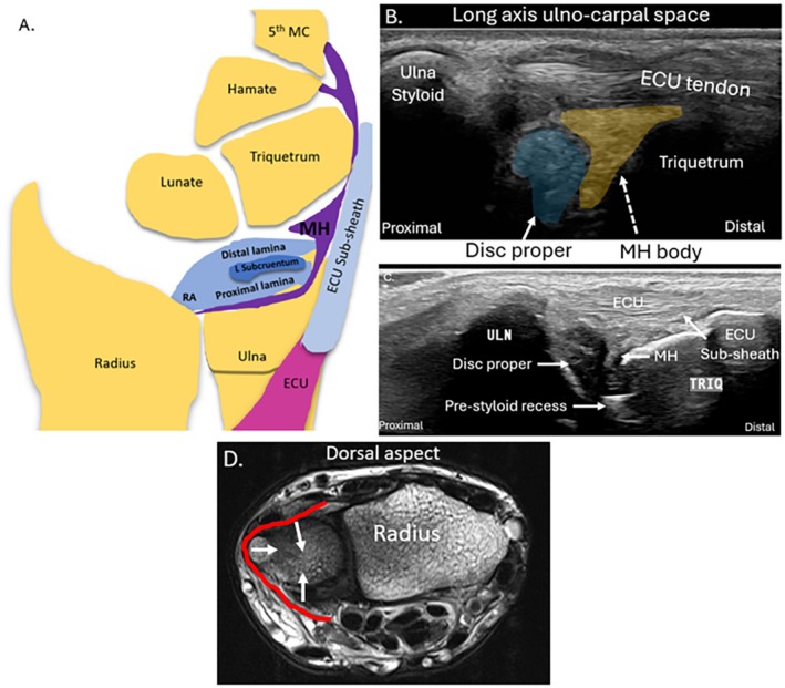 Diagrama, ecografías y resonancia que muestran el disco del complejo fibrocartílago triangular y el homólogo meniscal
