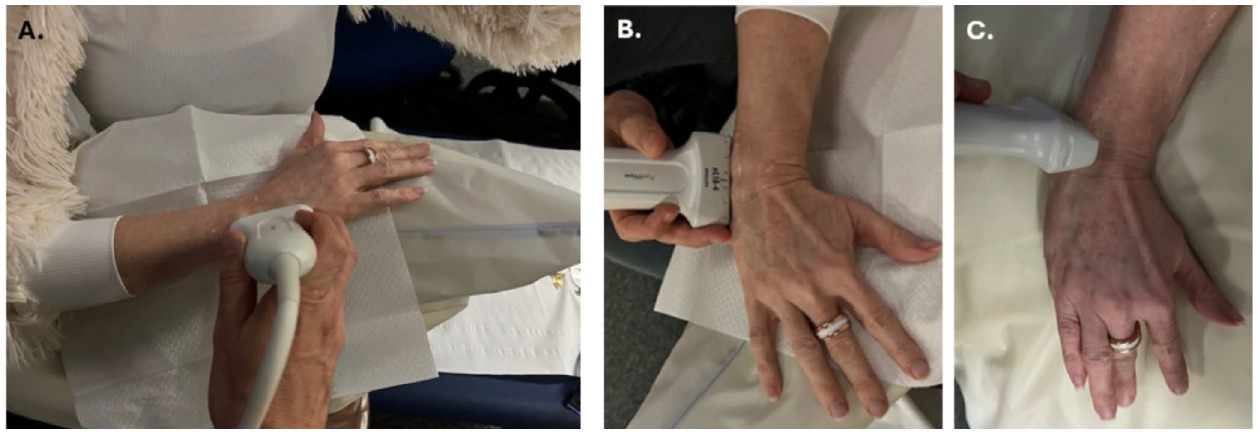Tres fotografías con posición del antebrazo y del transductor para explorar el lado cubital de la muñeca en ejes largo y corto
