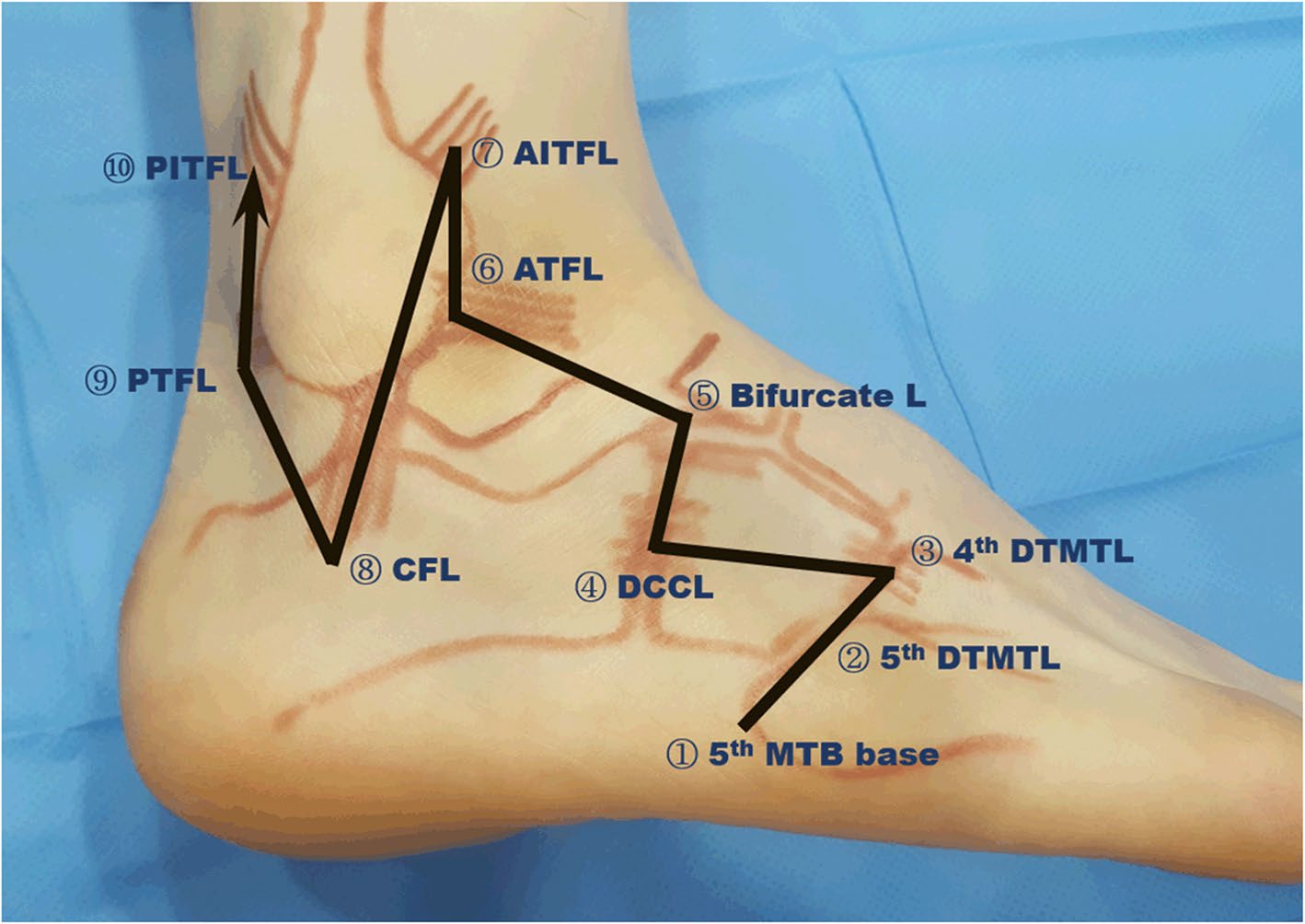 Mapa numerado de posiciones del transductor para explorar ligamentos laterales, mediotarsianos y sindesmóticos del tobillo