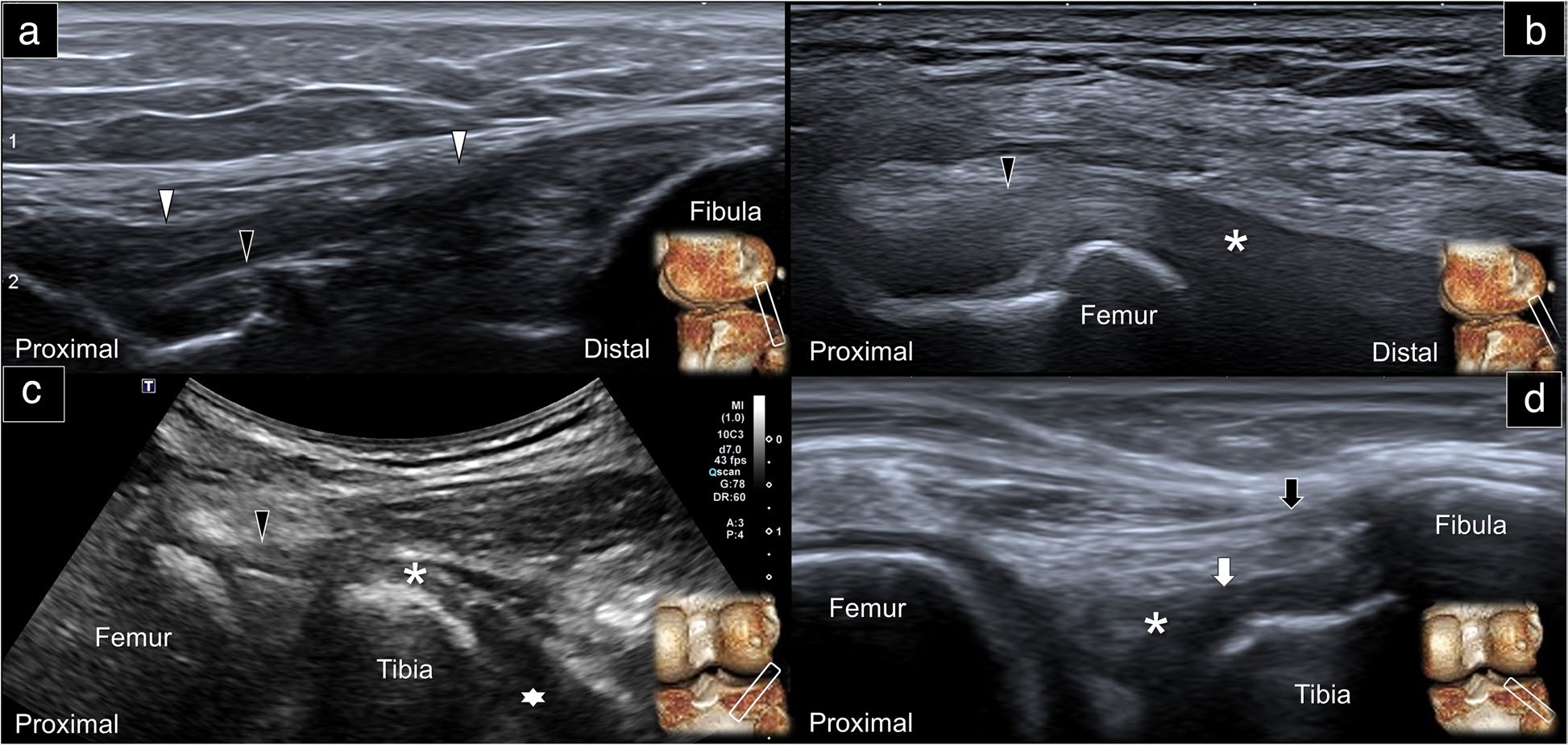 Serie ecográfica en eje largo del ligamento colateral lateral, poplíteo y ligamentos popliteofibular y arcuato