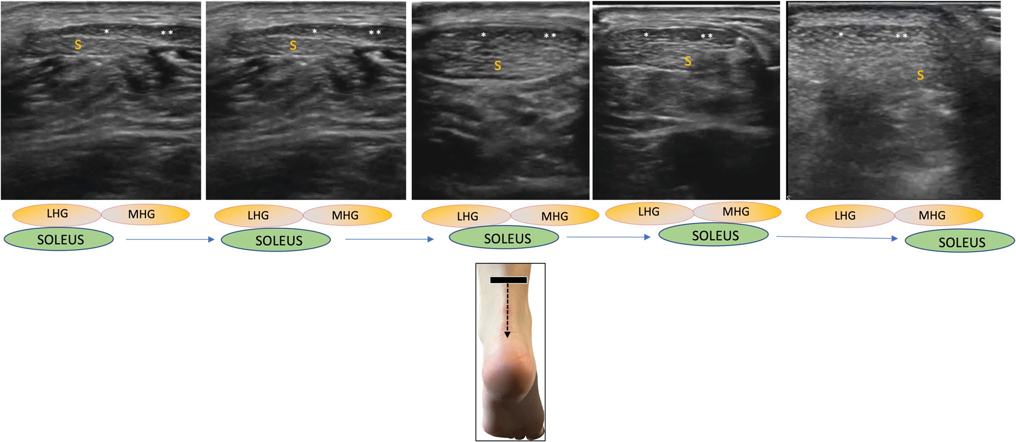 Secuencia ecográfica transversal del tendón de Aquiles que sigue los fascículos del gastrocnemio y sóleo hacia distal