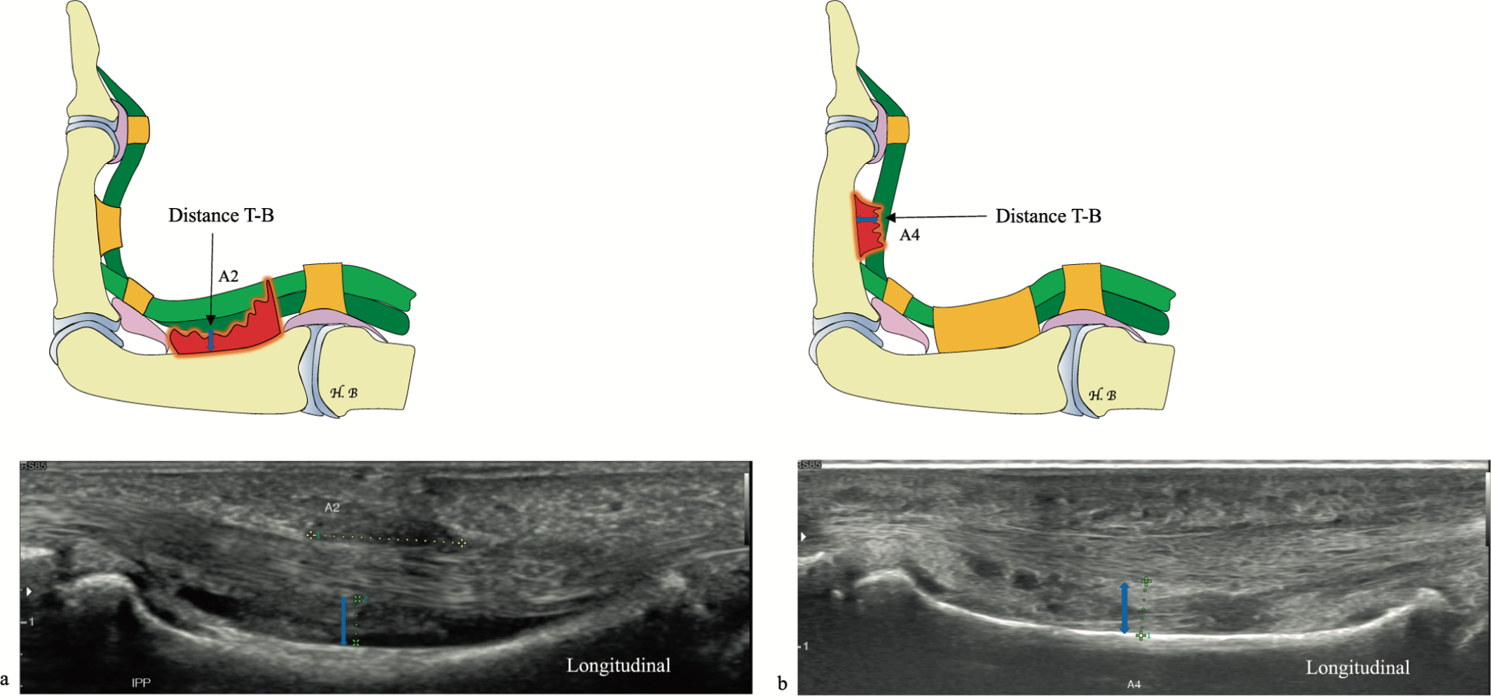Ecografías longitudinales de roturas A2 y A4 con aumento de la distancia entre tendón flexor y falange