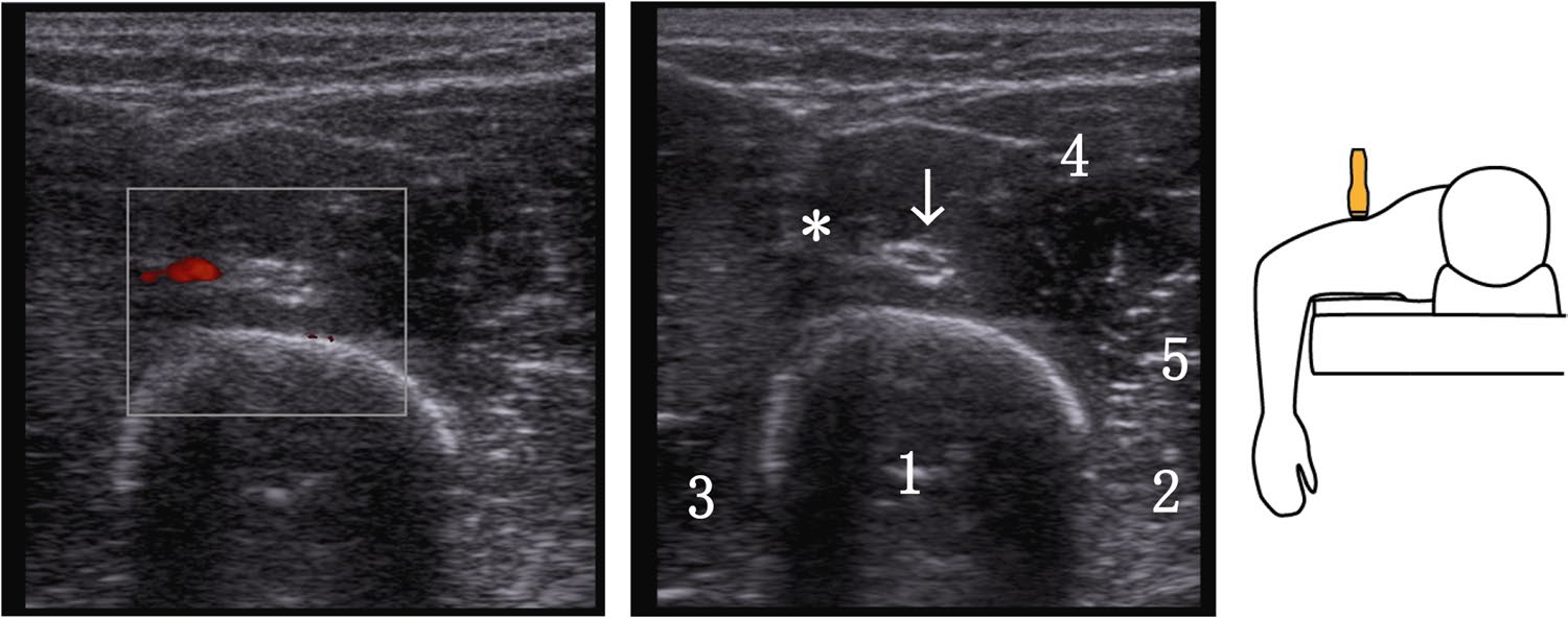 Ecografía con Doppler del nervio radial y la arteria braquial profunda sobre la cara dorsal del húmero
