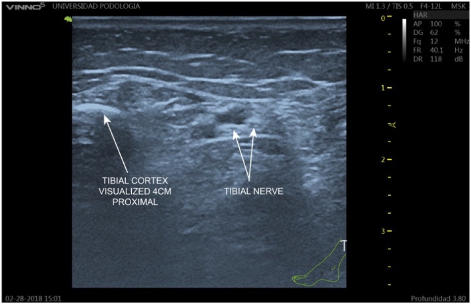Ecografía transversal supramaleolar con nervio tibial, arteria tibial posterior y cortical tibial señalados