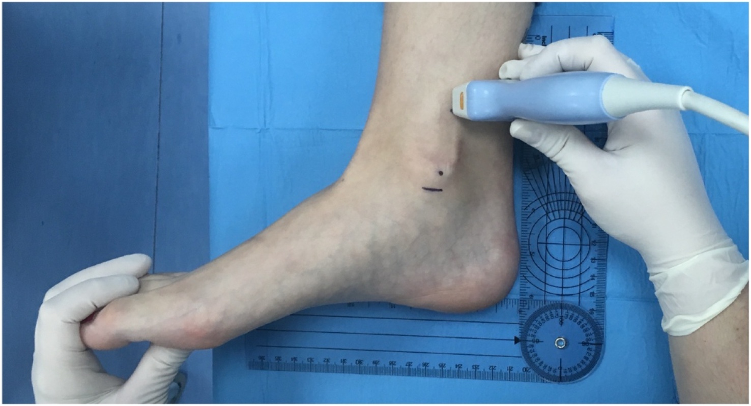 Posición transversal del transductor cuatro centímetros por encima del maléolo medial para localizar el nervio tibial