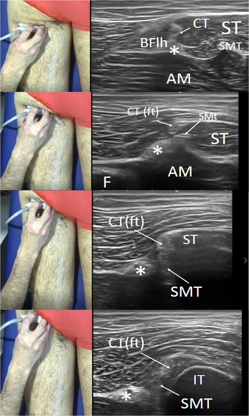 Serie de cuatro ecografías en eje corto del origen proximal de los isquiotibiales con posición correspondiente del transductor