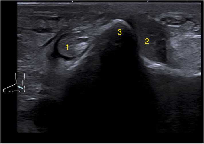 Ecografía transversal del tubérculo peroneal con los tendones peroneo largo y corto a cada lado