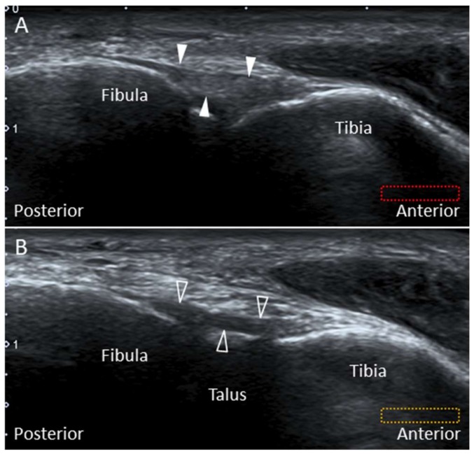 Ecografías del ligamento tibiofibular anterior inferior y el ligamento de Bassett entre tibia, peroné y talo