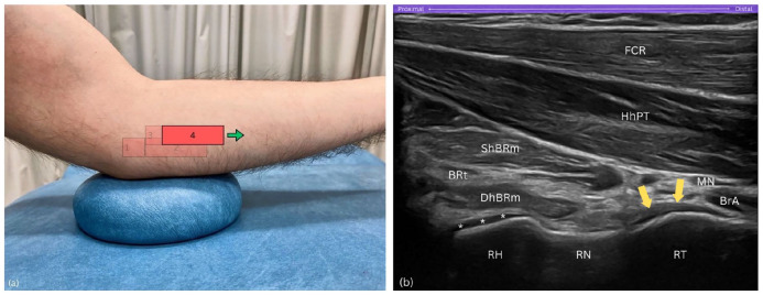 Posición del transductor y ecografía del arco formado por cabeza, cuello y tuberosidad radial